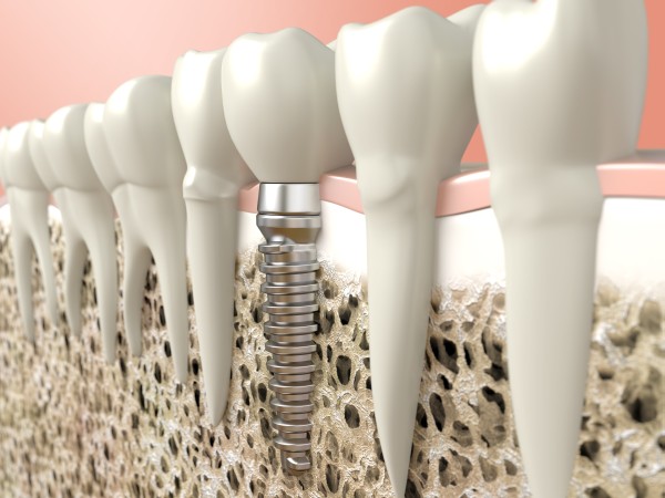 How Dental Implants Can Change Your Life