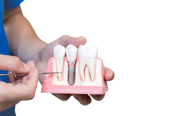 Dental Implants Nampa, ID