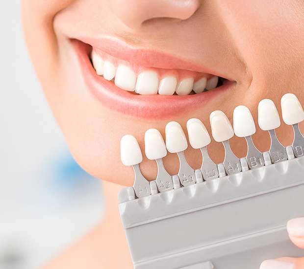 Nampa Dental Veneers and Dental Laminates