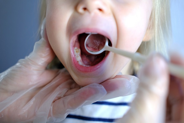 Types Of Dental Fillings For Kids Offered By A Kid Friendly Dentist In Nampa
